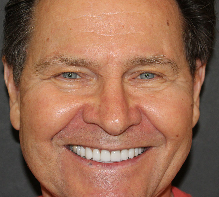 Jim Meisenheimer Smile Makeover at World Class Dentistry