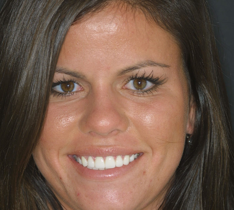 Lindsay Matern Smile Makeover at World Class Dentistry