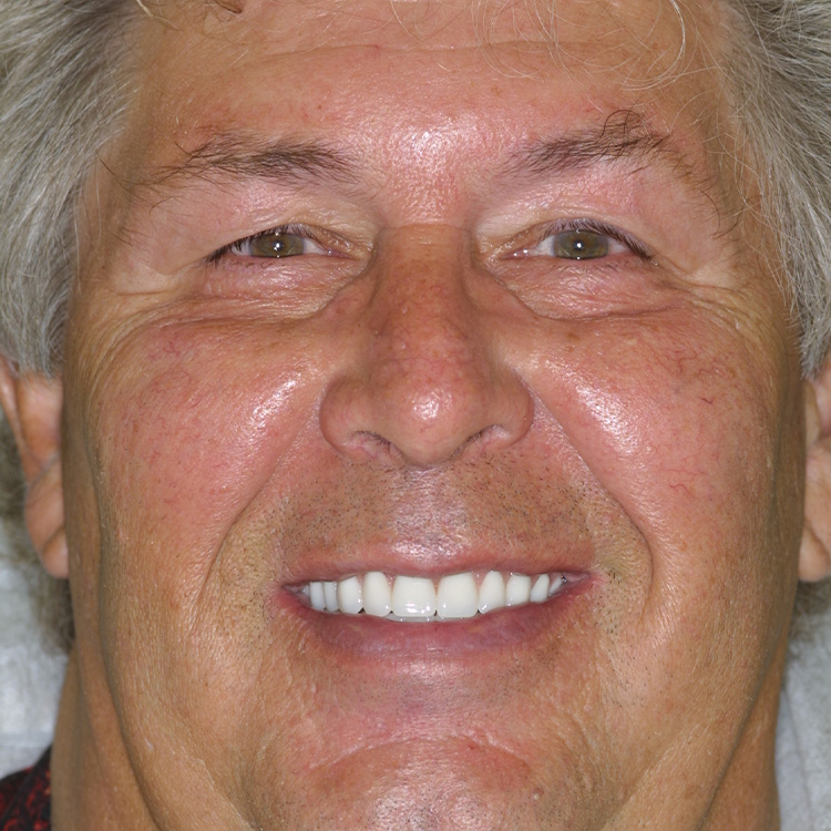Lonnie Buchner Smile Makeover at World Class Dentistry
