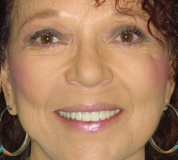 Tabitha Hall Smile Makeover at World Class Dentistry